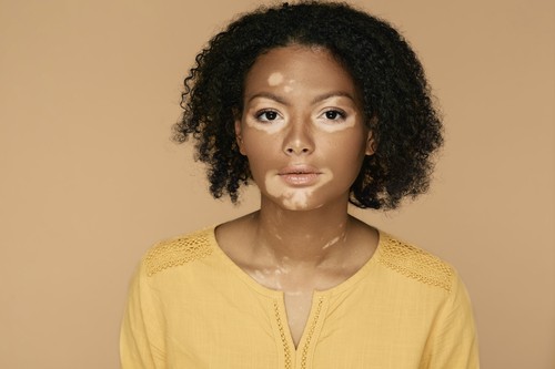 vitiligo